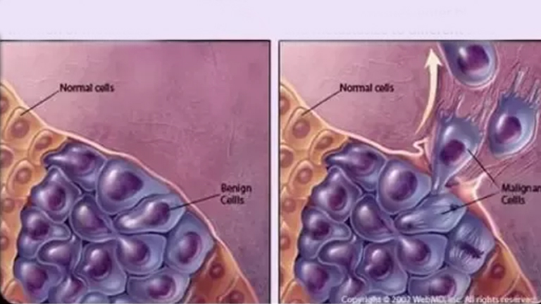 perbedaan tumor dan kanker